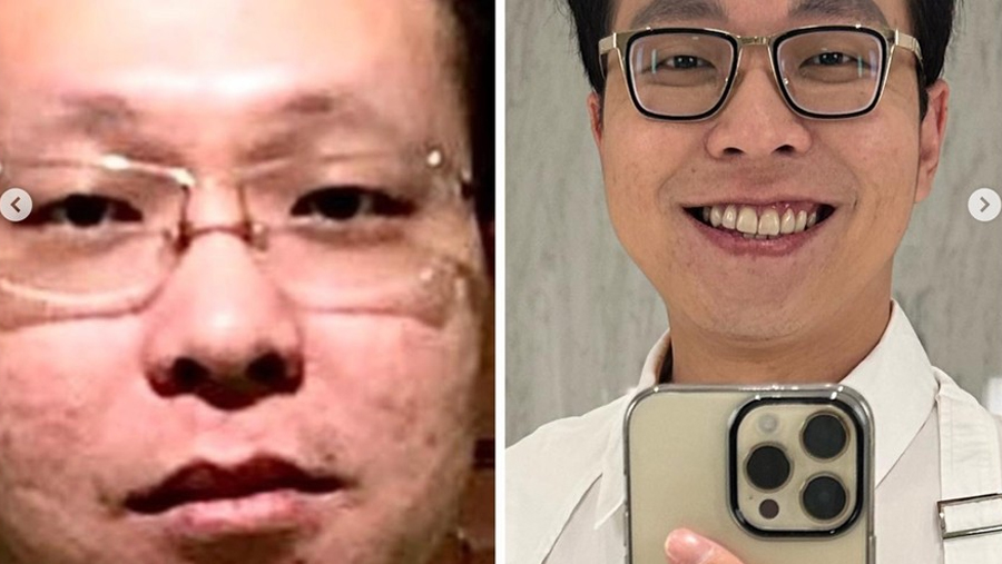 Wajah Bopeng Terungkap, Dr Richard Lee: Aku Sering Pencet Jerawat